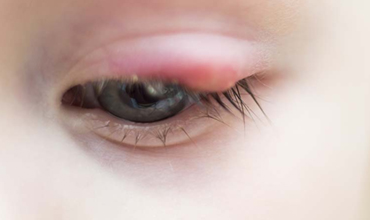 Chalazion: Bump on Eyelid