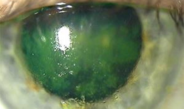 Neurotrophic Keratopathy