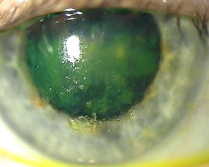 Eye suffering from Neurotrophic Keratitis