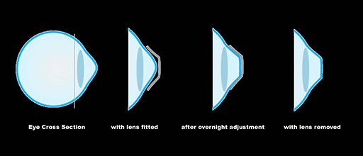 Stages of Non-Lasik Corneal Refractive Therapy Vision Correction